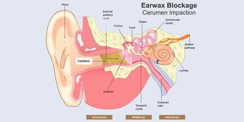 Earwax blockage diagram