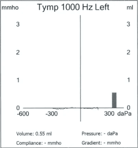Type B flat Tympanogram chart