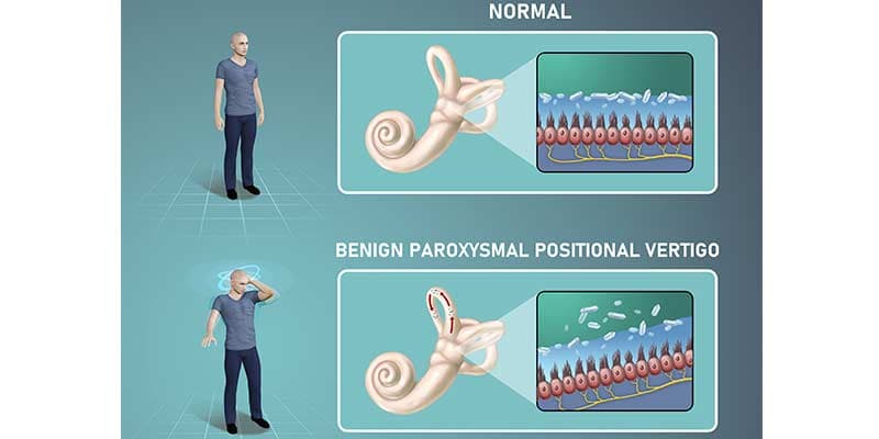 Benign Paroxysmal Positional Vertigo affects